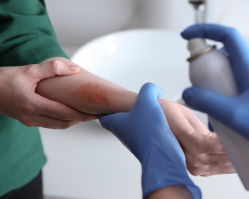 Vragenuurtje: Brandwonden op de Huisartsenspoedpost